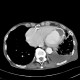 Loculated pleural fluid, aneurysm of left ventricle, apical and thrombosed, pneumothorax: CT - Computed tomography