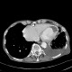 Loculated pleural fluid, aneurysm of left ventricle, apical and thrombosed, pneumothorax: CT - Computed tomography