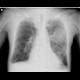 Loculated pleural fluid, aneurysm of left ventricle, apical and thrombosed, pneumothorax: X-ray - Plain radiograph