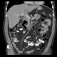 Parapapillary diverticulum of duodenum: CT - Computed tomography