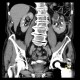 Parapelvic cysts of kidney, Paramo's syndrome: CT - Computed tomography