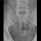 Ureterolithiasis, phleboliths: X-ray - Plain radiograph