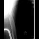 Osteolytic metastasis, pathological fracture of femur, osteosynthesis: X-ray - Plain radiograph