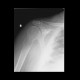 Pathological fracture of humerus, fracture: X-ray - Plain radiograph