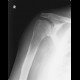 Pathological fracture of humerus, before fracture: X-ray - Plain radiograph