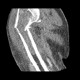 Pathological fracture of humerus: CT - Computed tomography