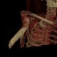 Pathological fracture of humerus, VRT: CT - Computed tomography