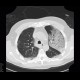 Pneumocystic pneumonia, atypical pneumonia: CT - Computed tomography