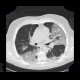 Pneumocystic pneumonia, atypical pneumonia: CT - Computed tomography