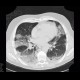 Pneumocystic pneumonia, atypical pneumonia: CT - Computed tomography