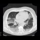 Pneumocystis pneumonia, PCP, Pneumocystis carinii: CT - Computed tomography