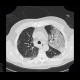 Pneumocystic pneumonia, atypical pneumonia: CT - Computed tomography