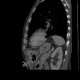Percutaneous endoscopic gastrostomy, PEG: CT - Computed tomography