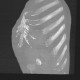 Percutaneous endoscopic gastrostomy, PEG: CT - Computed tomography