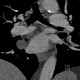 Pericardial cyst: CT - Computed tomography