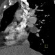 Pericardial cyst: CT - Computed tomography