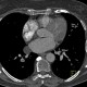 Pericardial cyst: CT - Computed tomography