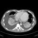 Perimyocarditis: CT - Computed tomography