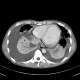 Perimyocarditis: CT - Computed tomography