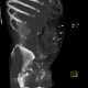 Unknown pathology, foreign bodies in peritoneal cavity: CT - Computed tomography