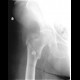 Pertrochanteric fracture, hardware migration, non-union: X-ray - Plain radiograph