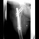 Pertrochanteric fracture, hardware migration, non-union: X-ray - Plain radiograph