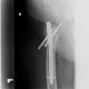 Pertrochanteric fracture, hardware migration, non-union: X-ray - Plain radiograph