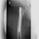 Pertrochanteric fracture, hardware migration, non-union: X-ray - Plain radiograph