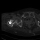 Pertrochanteric fracture, hardware migration, non-union: CT - Computed tomography