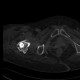 Pertrochanteric fracture, hardware migration, non-union: CT - Computed tomography