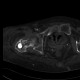 Pertrochanteric fracture, hardware migration, non-union: CT - Computed tomography