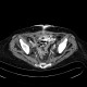 Tumour and fistula of the urinary bladder, fistula of small bowel: CT - Computed tomography