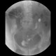 Tumour and fistula of the urinary bladder, fistula of small bowel, fistulography: RF - Fluoroscopy