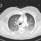 Lung oedema: CT - Computed tomography