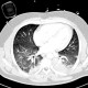 Lung oedema: CT - Computed tomography
