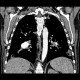 Pulmonary embolism, CT angiogram sign, pulmonary infarction: CT - Computed tomography