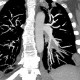Pulmonary embolism, CT angiogram sign, pulmonary infarction: CT - Computed tomography