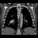 Pulmonary embolism, CT angiogram sign, pulmonary infarction: CT - Computed tomography