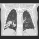 Pulmonary embolism, CT angiogram sign, pulmonary infarction: CT - Computed tomography