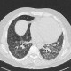 Lung fibrosis, alveolitis: CT - Computed tomography