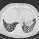 Lung fibrosis, alveolitis: CT - Computed tomography