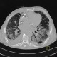 Lung fibrosis, pneumonia, pleural effusion: CT - Computed tomography