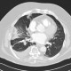 Lung infarction, development in time, initial examination: CT - Computed tomography