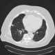Lung infarction, development in time, follow-up: CT - Computed tomography