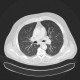 Welder's lung, pulmonary siderosis: CT - Computed tomography