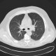 Welder's lung, pulmonary siderosis: CT - Computed tomography