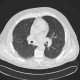Welder's lung, pulmonary siderosis: CT - Computed tomography