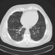 Welder's lung, pulmonary siderosis: CT - Computed tomography