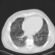 Welder's lung, pulmonary siderosis: CT - Computed tomography