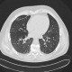 Welder's lung, pulmonary siderosis: CT - Computed tomography